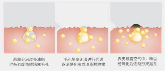 去黑头仪器有用吗？连根拔起实在是太爽啦