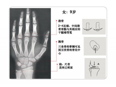 孩子骨龄与身高对照表，家长该收藏